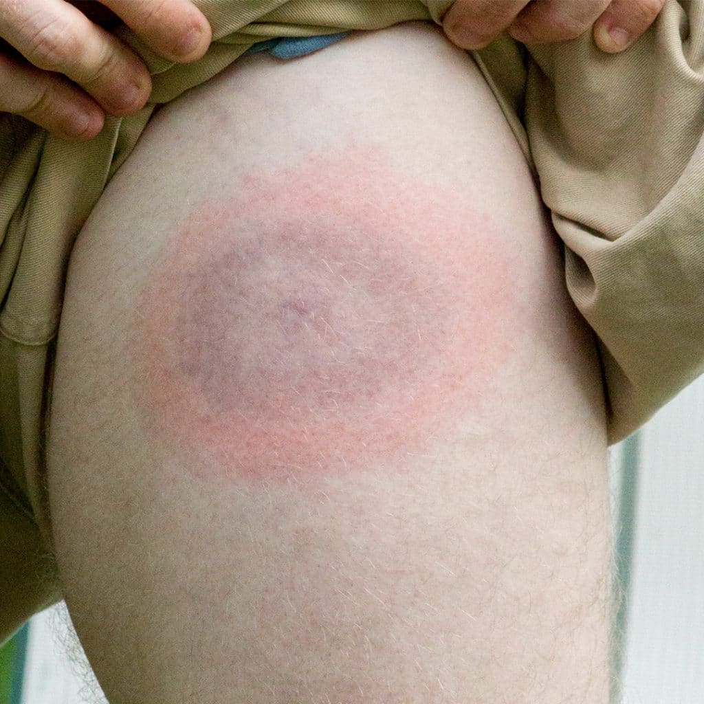 Signs And Symptoms Of Lyme Disease ExtermPRO   Lyme Disease 1024x1024 