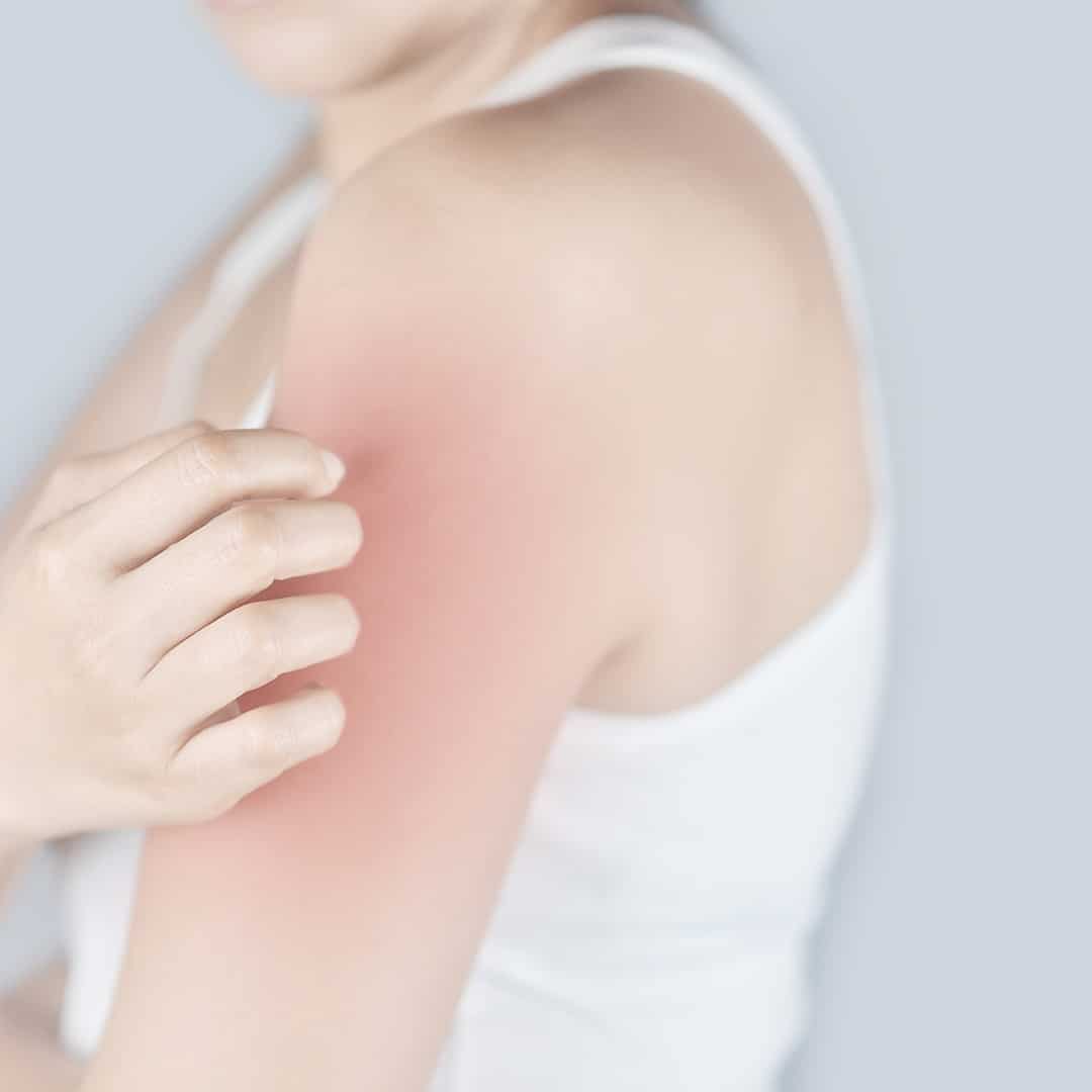 how-to-get-a-mosquito-bite-to-stop-itching-extermpro